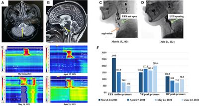 Botulinum toxin injection combined with traditional swallowing rehabilitation improved cricopharyngeal dysfunction in neuromyelitis optica spectrum disorder: A case report